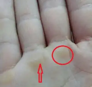 Hand with hardened skin